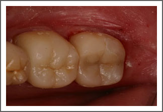 Teeth after crown treatment