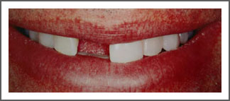 Mouth/teeth before dental implant treatment