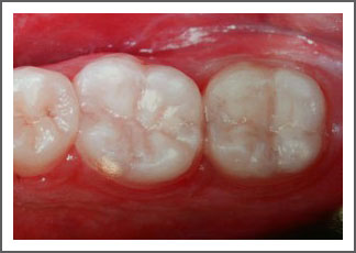 Teeth after colored restoration treatment