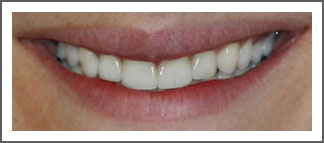 Mouth/teeth after veneers treatment