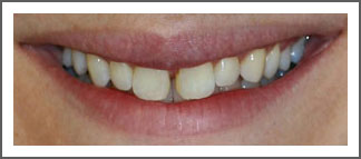 Mouth/teeth before veneers treatment